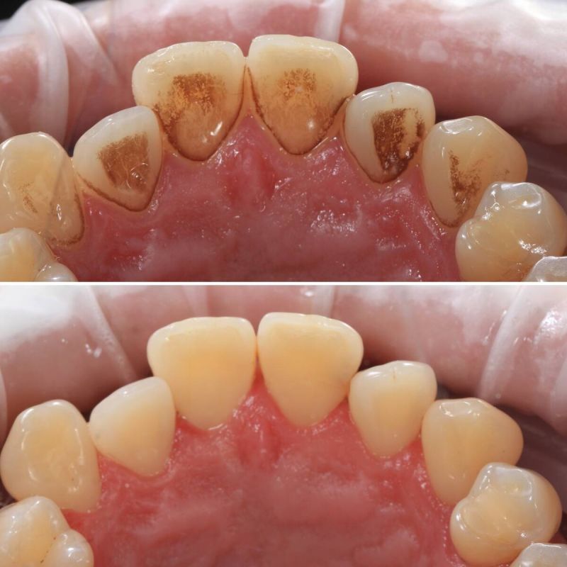 Желтый и темный налет: причины и последствия