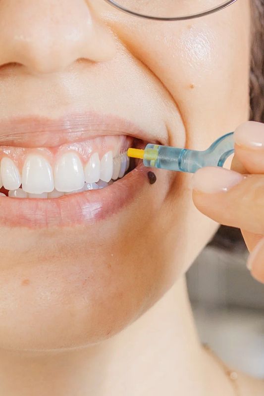 Восстановление белизны зубов: миф или реальность?